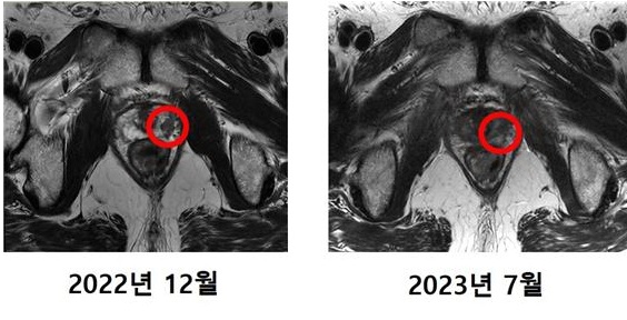 최씨의 MRI 촬영 사진. 기존에 발견됐던 암 조직(왼쪽)이 치료 후에는 발견되지 않았다. (사진=세브란스병원 제공)